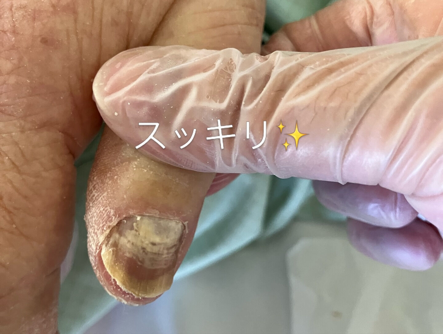 爪が分厚くなってしまったり、爪垢がぎっしりと詰まってしまうと